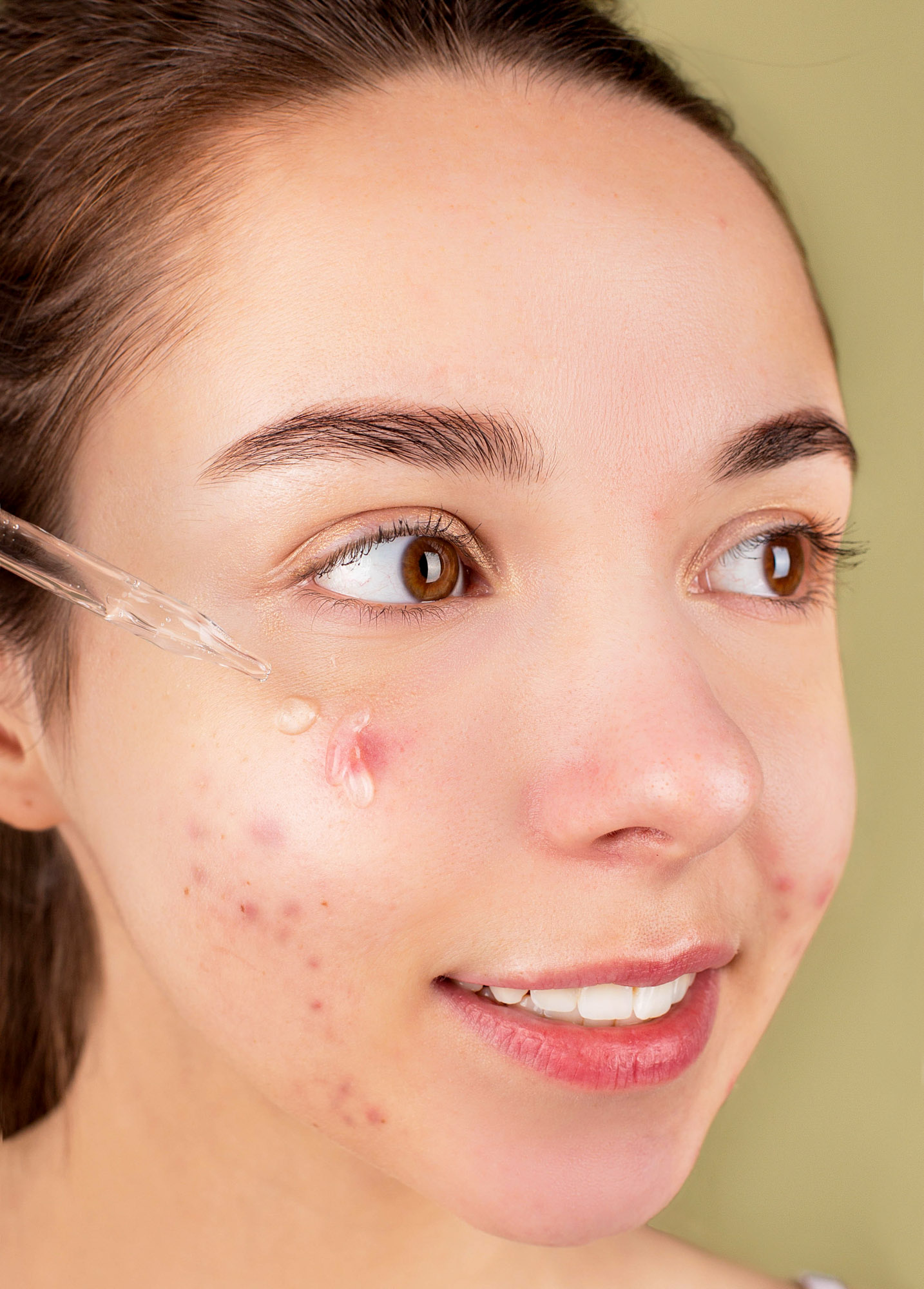 Retinol en pieles con acné